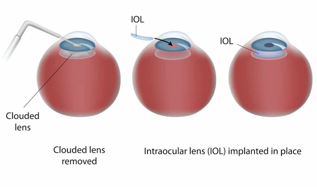 Chart illustrating the cataract surgery process