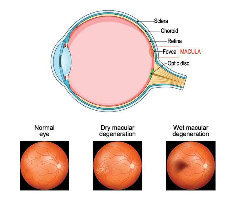 Chart illustrating how dry/wet macular degeneration affects an eye